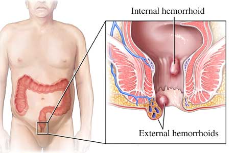 Get treatment for internal hemorrhoids while pregnant